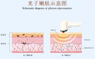 光子嫩膚術(shù)前注意事項有哪些？