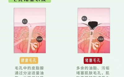 毛孔堵塞怎么疏通毛孔？